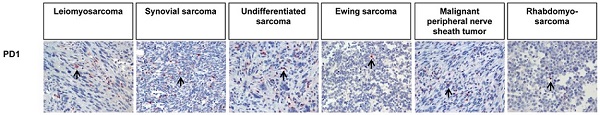 DAB staining identifies PD1 localization in various tumor samples (colored brown). Cell bodies are stained in blue.